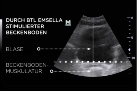 Ultraschallbild eines Beckenbodens während der Stimulation